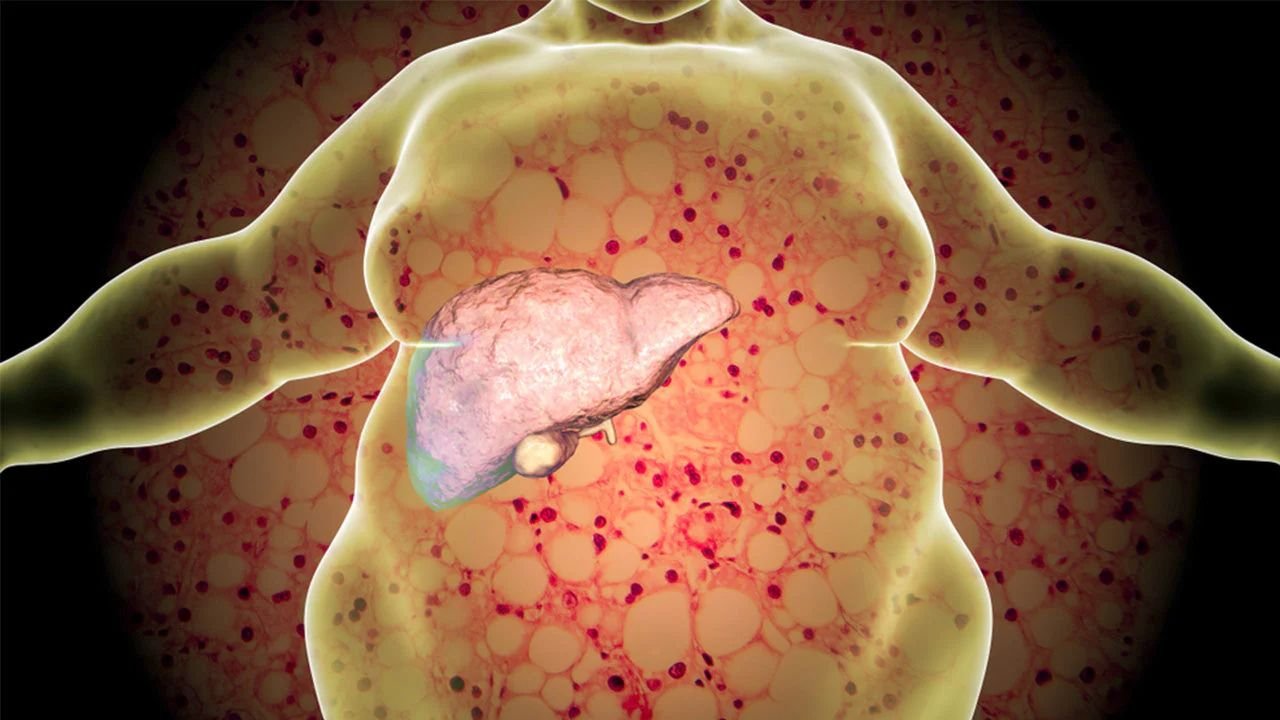 Fatty Liver Symptoms: फैटी लीवर के 5 आम संकेत, जिन्हें नजरअंदाज करना हो सकता है खतरनाक